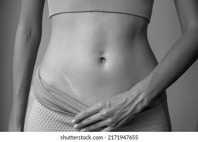 A black and white photo of an appendicitis scar on a young athletic woman