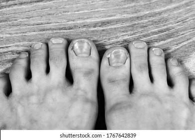 Black And White Photo Broken And Ingrown Ugly Toenails Of A Sloppy Girl