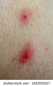 Blackfly Bite Marks On Human Skin