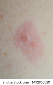 Blackfly Bite Marks On Human Skin