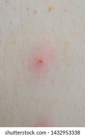 Blackfly Bite Marks On Human Skin Stock Photo 1432953338 