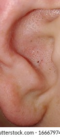 Blackheads In Ear Of Caucasian Person