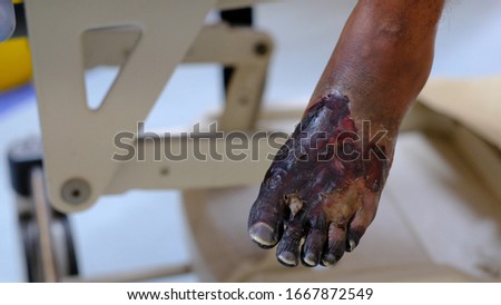 Blackish discolouration of foot in Dry Gangrene due to arterial occlusion .
