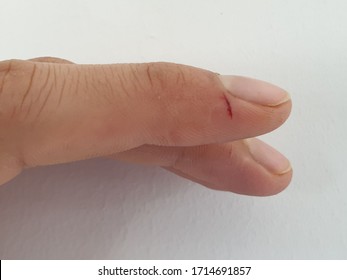 Bleeding from the cut finger 