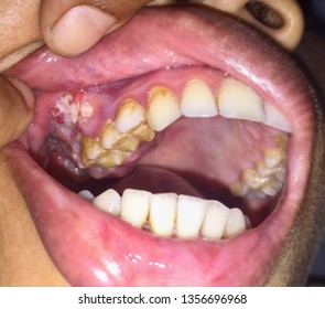 Bleeding, Inflamed Ulcerative Growth At Right Upper Gum In Oral Cavity Of Asian, Myanmar Female And The Diagnosis Is Oral Cancer - Gum