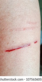 Bleeding Painful Cat Scratched Wound Painful.  The Wound Can Swell, Become Infected And Make Us Sick. Minor Cat Scratches Usually Can Be Treated At Home.