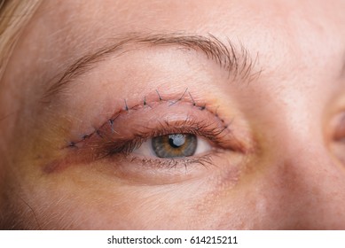 Blepharoplasty Of The Upper Eyelid.