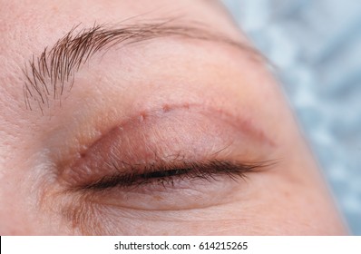 Blepharoplasty Of The Upper Eyelid.