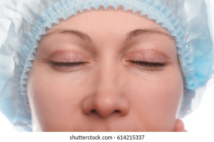 Blepharoplasty Of The Upper Eyelid.