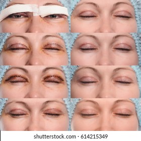 Blepharoplasty Of The Upper Eyelid.