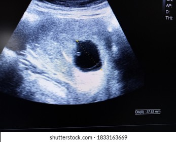 blighted ovum by ultrasound scan - Shutterstock ID 1833163669