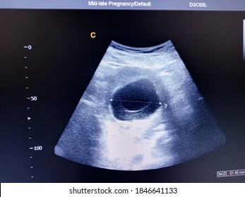 Blighted Ovum By Ultrasound Scan Stock Photo (Edit Now) 1846641133