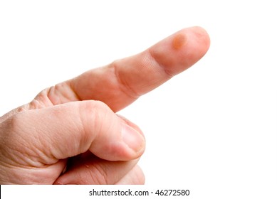 Blister