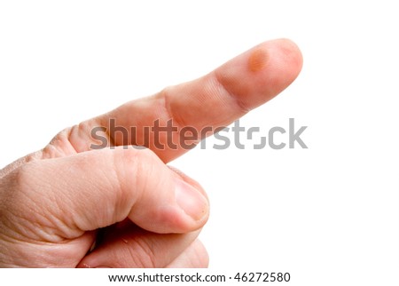 Blister