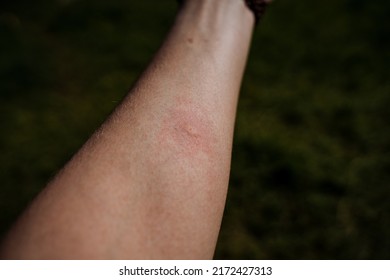 A Blister Mark From A Midge Bite On The Human Body, A Red Spot From A Mosquito Bite, Reddening Of The Skin, Itching On The Body. High Quality Photo