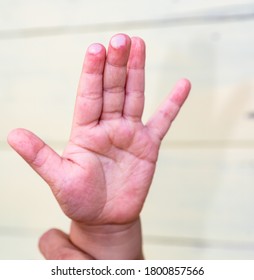 blister on children finger caused by hot water injury - Shutterstock ID 1800857566