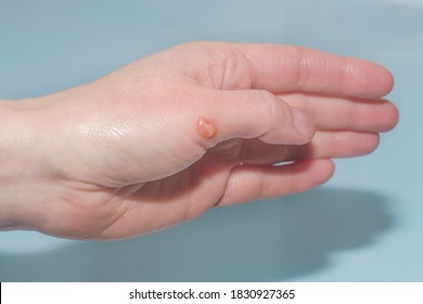 A Blister On The Hand After A Burn