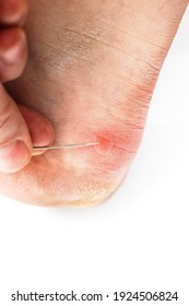 Blister on heel gets pricked with needle to burst it on white background, close-up with selective focus. - Shutterstock ID 1924506824