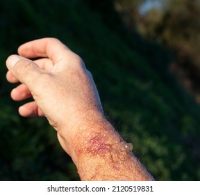 A blistered forearm badly affected by phytophotodermatitis.