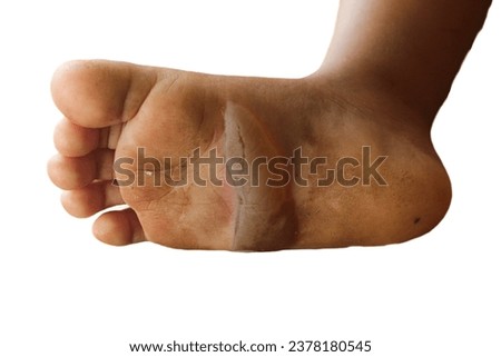 blistered soles of feet isolated white background