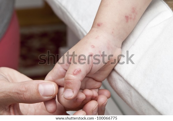 子どもの手と腕に帯状疱疹が起こる水疱 の写真素材 今すぐ編集