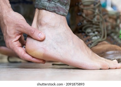 Blisters On The Foot Of A Caucasian Military Man Sitting On The Couch