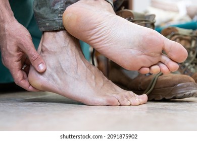 Blisters On The Foot Of A Caucasian Military Man Sitting On The Couch