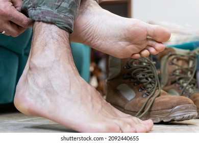 Blisters On The Foot Of A Caucasian Military Man Sitting On The Couch