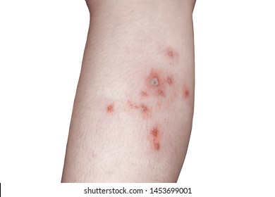 Purulent Wound Images, Stock Photos & Vectors | Shutterstock