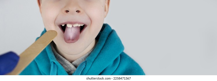 Blond boy has a white tongue. Painful white coating on the mucous membrane of the tongue. Diseases of the gastrointestinal tract, liver and gallbladder. The consequences of taking antibiotics. - Shutterstock ID 2258471367