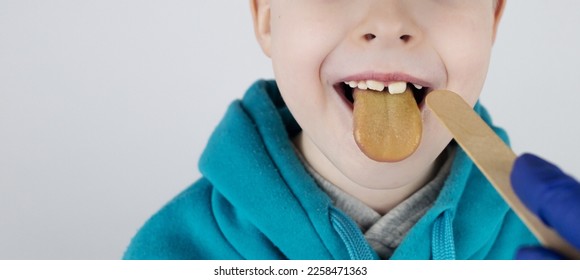 Blond boy has a yellow tongue. Painful yellow coating on the mucous membrane of the tongue. Diseases of the gastrointestinal tract, liver and gallbladder. The consequences of taking antibiotics. - Shutterstock ID 2258471363