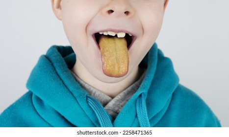 Blond boy has a yellow tongue. Painful yellow coating on the mucous membrane of the tongue. Diseases of the gastrointestinal tract, liver and gallbladder. The consequences of taking antibiotics. - Shutterstock ID 2258471365
