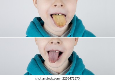 Blond boy has a yellow tongue. Painful yellow coating on the mucous membrane of the tongue. Diseases of the gastrointestinal tract, liver and gallbladder. The consequences of taking antibiotics. - Shutterstock ID 2258471373