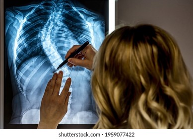 Blonde Female Physician Looking At A Patients X-ray. Scoliosis Specialist Doctor Making Measurements At The Patients X-Ray
