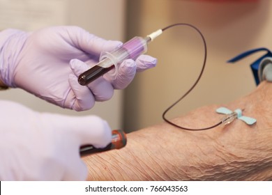 Blood being drawn, donated or for testing, of elderly woman. Shows one tube and Doctor or nurse with purple gloves. One hand, Phlebotomy, with two full tubes. 