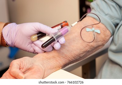 Blood being drawn, donated or for testing, of elderly woman. Shows one tube and Doctor or nurse with purple gloves. One hand, Phlebotomy, two tubes in hand. 