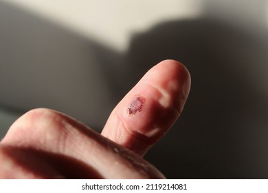 A Blood Blister On A Thumb. Minor Injury Caused By Severe Pinch.