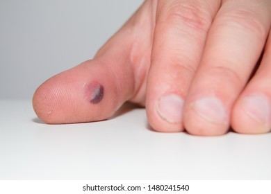 Royalty Free Blood Blister Stock Images Photos Vectors