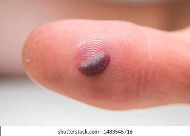 Royalty Free Blood Blister Stock Images Photos Vectors