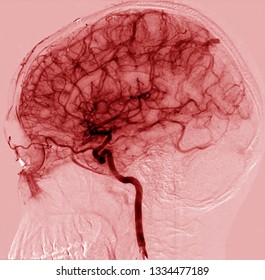 Blood Circulation Of Human Brain In Lateral View