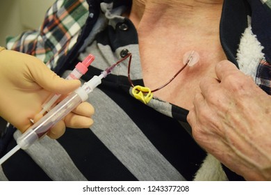 Blood Collection Before Chemotherapy By A Port On An Old Man's Chest