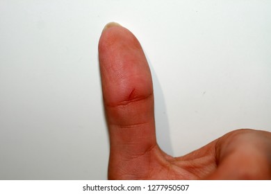 Thumb swollen throbbing Swollen Finger