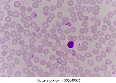 Blood Films For Malaria Parasite.show Malaria Pigment.