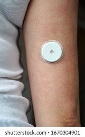 Blood Glucose Monitoring Sensor Called FreeStyle Libre Attached To An Arm. Type1 Diabetes