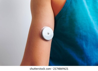 Blood Glucose Sensor On A Child's Arm.  Sensor For Remote Measurement Of Blood Glucose Levels Using NFC Technology On A Mobile Phone Or Reader 