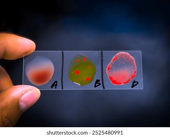 Blood group and Rh factor testing by slide agglutination method. Blood typing. B Positive.