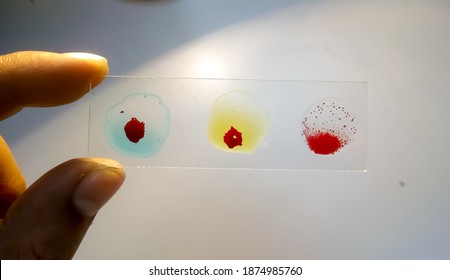 Blood group testing by slide agglutination method. abo blood grouping