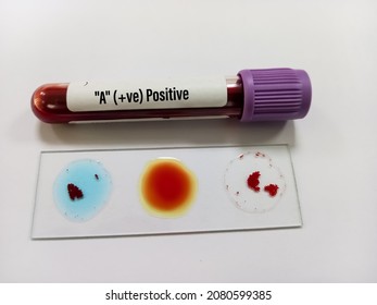 Blood group testing by slide agglutination method with sample, A Positive blood group. medical concept