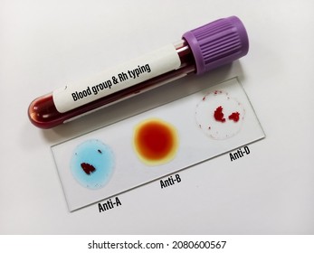 Blood group testing by slide agglutination method with sample, A Positive blood group. medical concept