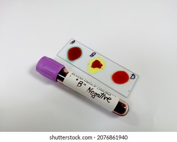 Blood Grouping By Slide Agglutination Method With Blood Sample. Blood Typing. B Negative. Rare Blood Group.